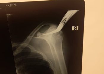 Hasil rontgen celurit nancap di bahu ojol korban pembacokan di Bantul