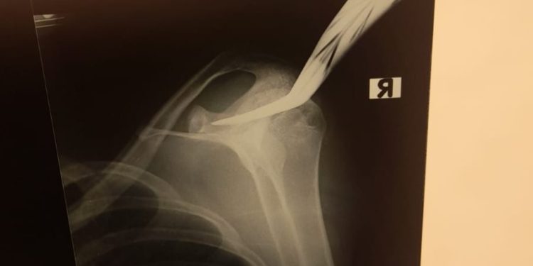 Hasil rontgen celurit nancap di bahu ojol korban pembacokan di Bantul