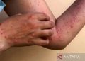 Waspada: Risiko Mpox Masih Mengancam Kanada