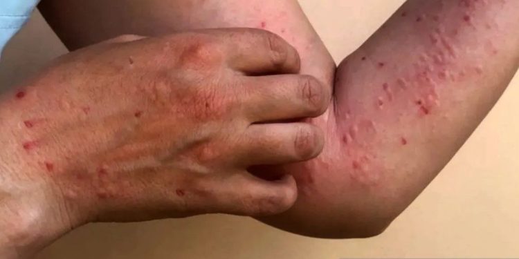 Cacar Monyet Sudah di Jakarta Selatan, Segera Lakukan Pencegahan!