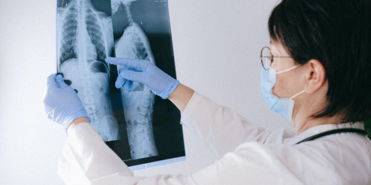 Waspada: Gejala Kanker Paru yang Tersembunyi dan Harus Diketahui untuk Deteksi Awal