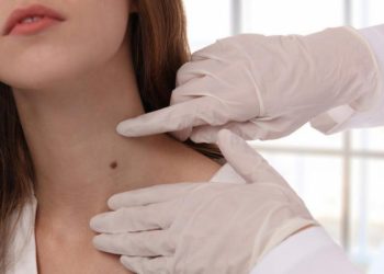 8 Rahasia Ampuh Hilangkan Tahi Lalat Tanpa Repot