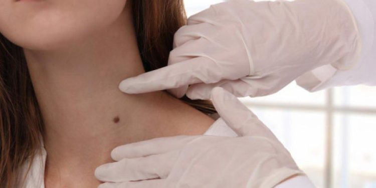 8 Rahasia Ampuh Hilangkan Tahi Lalat Tanpa Repot