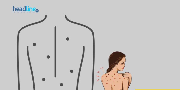 ilustrasi gambar jerawat di badan