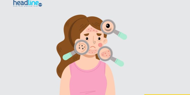 Apa Itu Acne Care