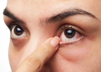 Benarkah Kentut Menyebabkan Mata Merah? Ini Penjelasannya