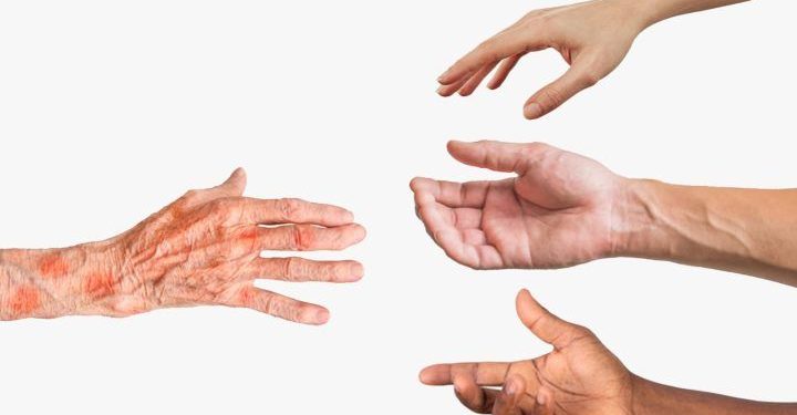 Kasus Kusta pada Anak di Gorontalo Masih Menjadi Perhatian