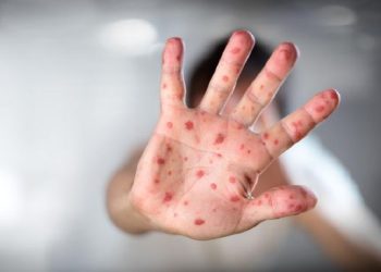 Kemenkes Perketat Pengawasan Usai Kasus Campak Dilaporkan dari Indonesia ke Australia