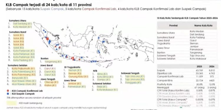 Risiko Komplikasi Campak pada Dewasa Lebih Tinggi