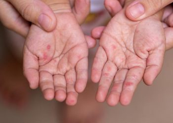 Dosen UGM Peringatkan Risiko Penularan Campak Saat Mudik Lebaran