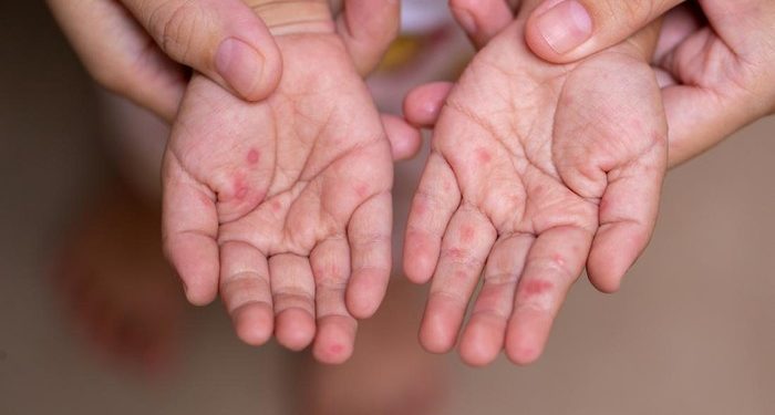 Dosen UGM Peringatkan Risiko Penularan Campak Saat Mudik Lebaran