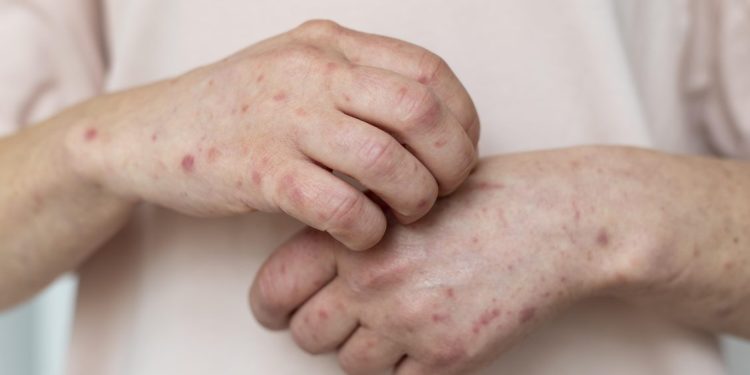 Kemenkes Instruksikan Peningkatan Perlindungan Terhadap Campak di Kalangan Tenaga Kesehatan