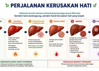 Pentingnya Deteksi Dini untuk Mencegah Kerusakan Hati