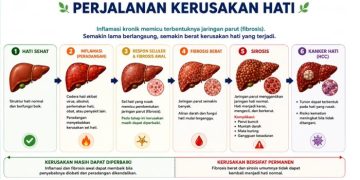 Pentingnya Deteksi Dini untuk Mencegah Kerusakan Hati