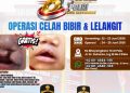 Polda Sulteng Adakan Operasi Gratis untuk Celah Bibir, Katarak, dan Pterygium
